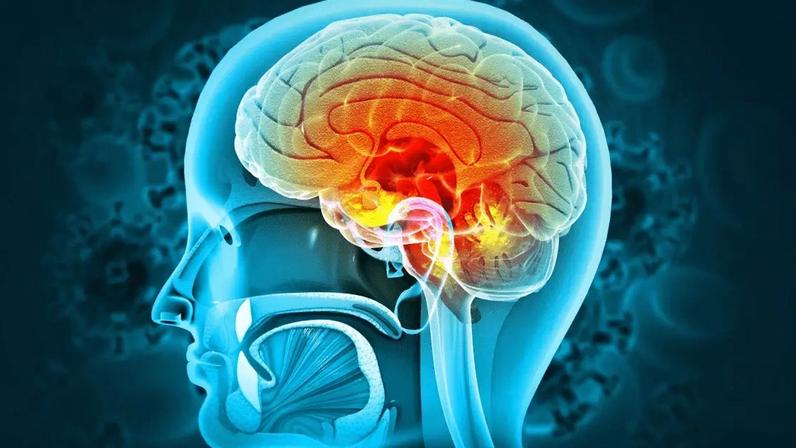 A meningite é a inflamação das meninges, causada por vírus, bactérias, fungos ou parasitas, que afeta cérebro e medula espinhal