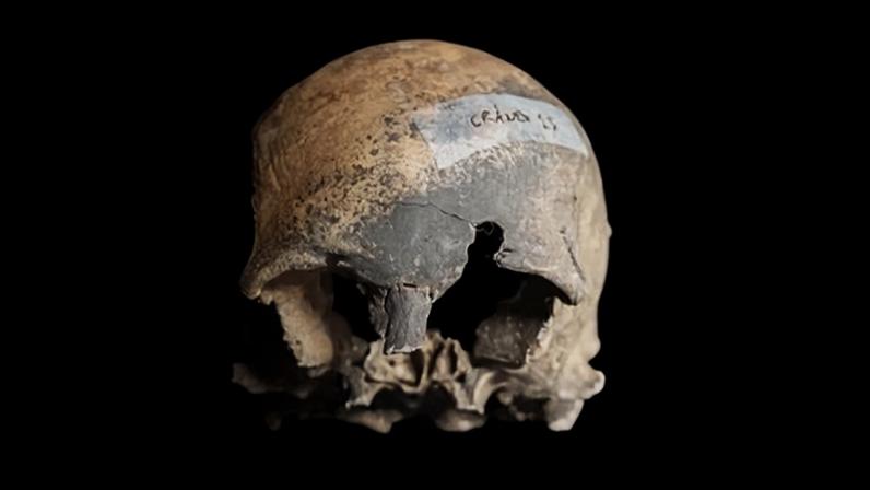 A human skull with visible damage to the eye sockets and forehead, viewed from the front against a black background