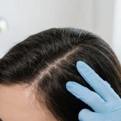 Vinagre de maçã diluído no couro cabeludo com caspa: benefícios e como usar