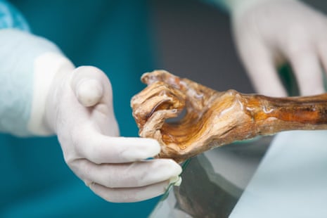 A researcher examines the hand of the naturally mummified remains of Ötzi, a man whose body was preserved in glacial ice for more than 5,300 years.