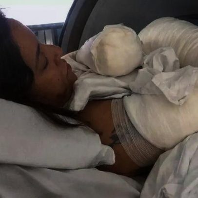 Ana Maria enfrenta a recuperação de queimaduras graves