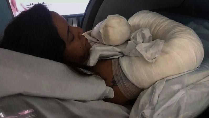 A luta de Ana Maria pela recuperação de queimaduras graves