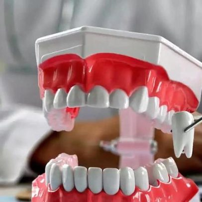 Dente do siso: por que ele aparece e quando a extração é necessária