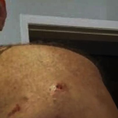 Jornalista José Roberto Burnier é ferido em ataque de pitbull durante caminhada