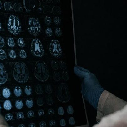 BrainAge indica idade cerebral por meio de tecnologia
