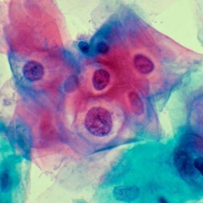 Entraves para a vacinação contra HPV no Brasil limitam avanços