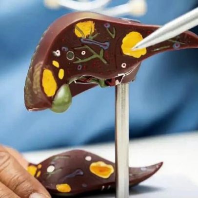 Gordura no fígado não vem da gordura da comida; entenda o que pode levar ao problema