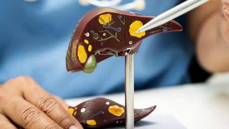 O perigo para o fígado não está só nas frituras: o excesso de açúcar e farinhas brancas também pode causar acúmulo de gordura.