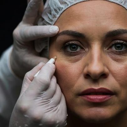 Cirurgia de pálpebras melhora aparência e visão dos pacientes