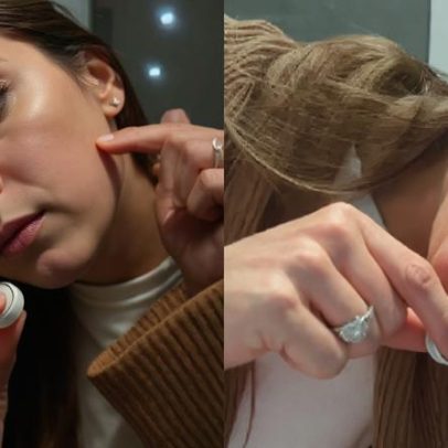 Maíra Cardi mostra complicações de preenchimento facial e alerta: é proibido