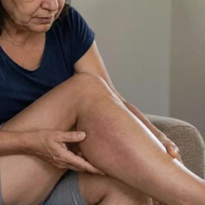 Nem toda trombose começa grave; sinais costumam ser ignorados
