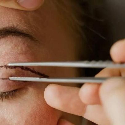 Blefaroplastia: quando a cirurgia de pálpebras é indicada