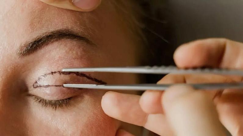 Blefaroplastia