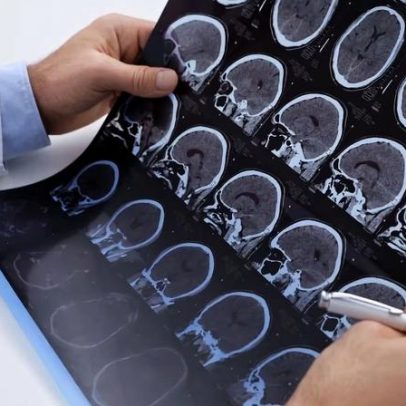 Esclerose múltipla cresce globalmente; diagnóstico precoce é decisivo