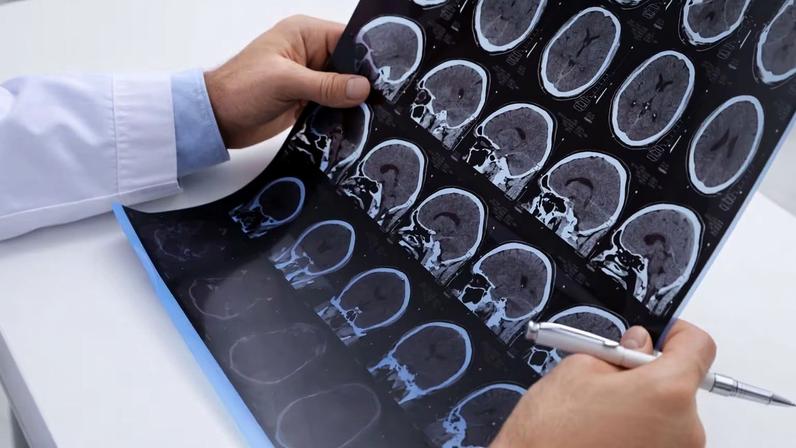 Esclerose múltipla cresce globalmente; diagnóstico precoce é decisivo