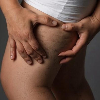 Lipedema pode também acometer homens e ser confundido com sobrepeso