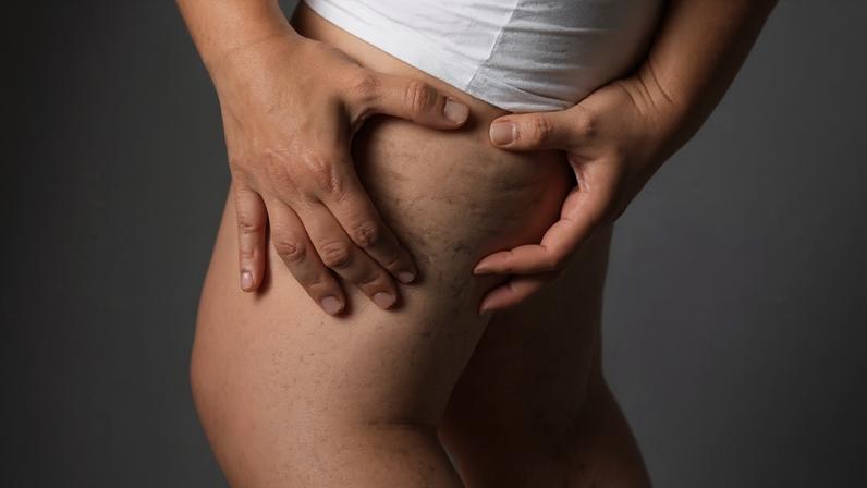 Apesar dos casos serem raros, a doença pode afetar homens e é erroneamente confundida como sinônimo de obesidade.