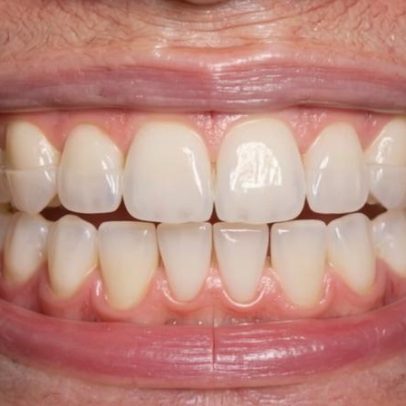 Dentes reagem ao aperto prolongado da mandíbula sem placa de bruxismo