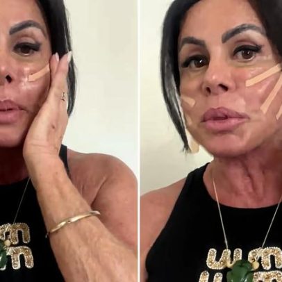 Gretchen revela nova série de procedimentos estéticos em seu rosto