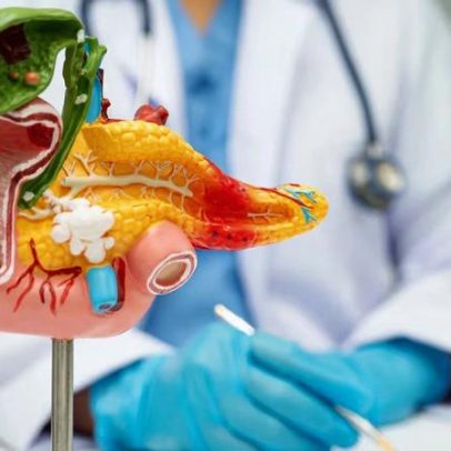 Novo comprimido aumenta sobrevida de câncer de pâncreas metastático