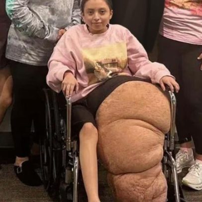 Garota revela como ficou meses após cirurgia na perna de 79 kg