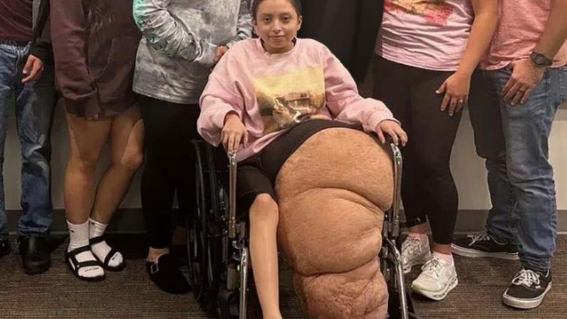 Garota Jasmine meses depois de operar a perna