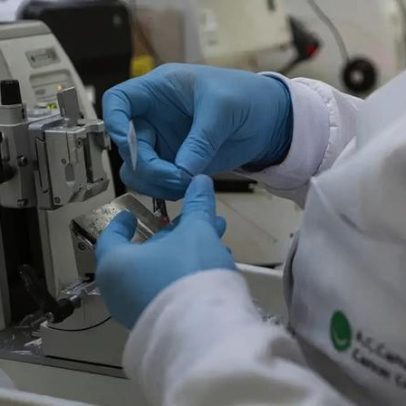 SUS oferecerá nova terapia para adultos com leucemia mieloide