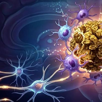 Descoberta reprograma células cerebrais e reduz placas de Alzheimer