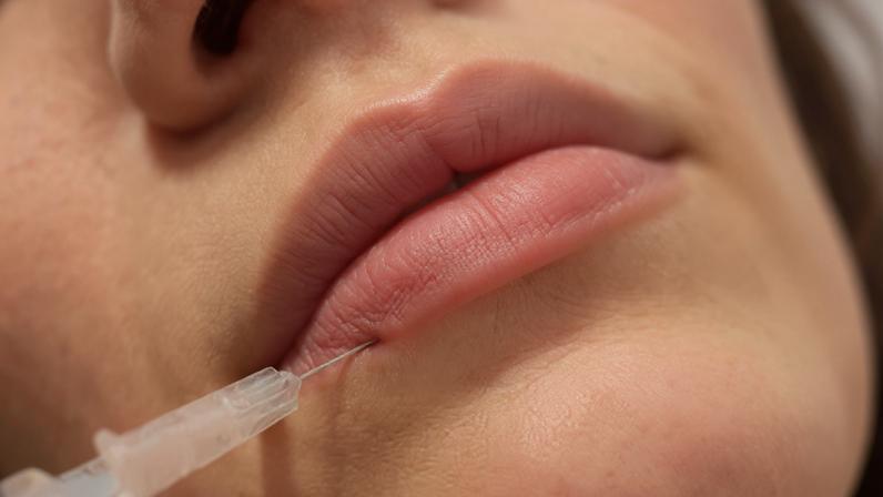 PMMA é usado em procedimentos como preenchimento labial, mas não é indicado pela Anvisa
