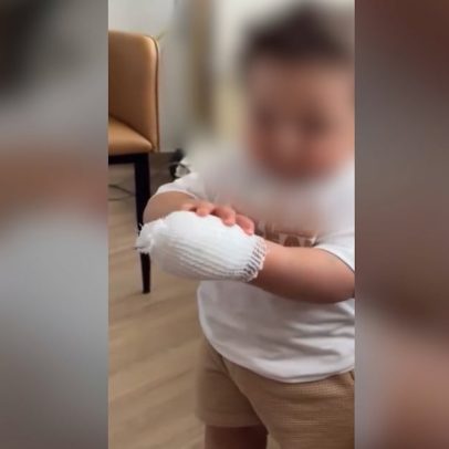 Queimaduras em crianças durante festas juninas preocupam especialistas