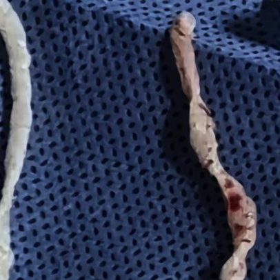 Médicos removem vermes vivos de 10 cm do braço de mulher na China