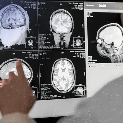 Estudo monitora como a anestesia atua no cérebro