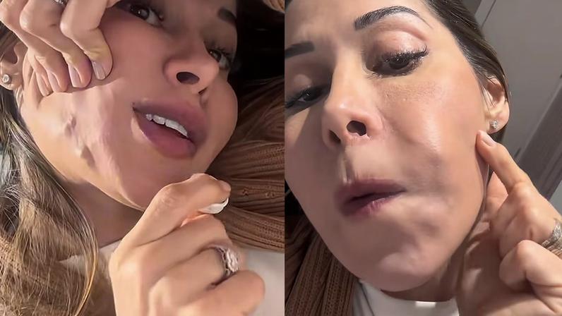 Maíra Cardi expôs complicações no rosto 20 anos após PMMA
