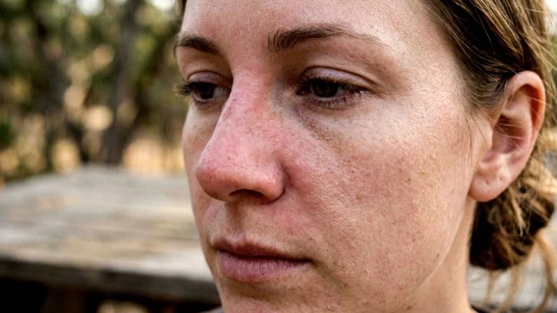 Descamação no nariz pode indicar problema mais sério na pele
