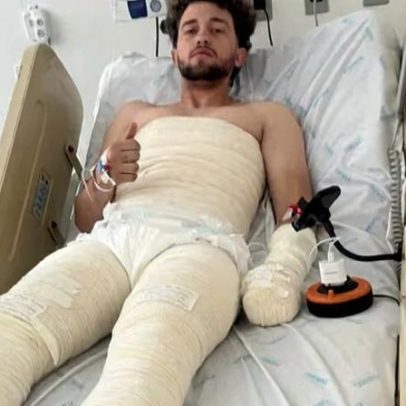 Jovem sofre queimaduras de 50% do corpo após amigo atear fogo em barraca em MG