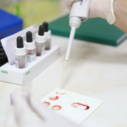 Estudo negativo abriu caminho para rastrear câncer com exame de sangue