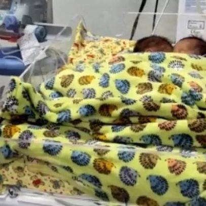 Bebês siameses morrem após infecção em Goiás