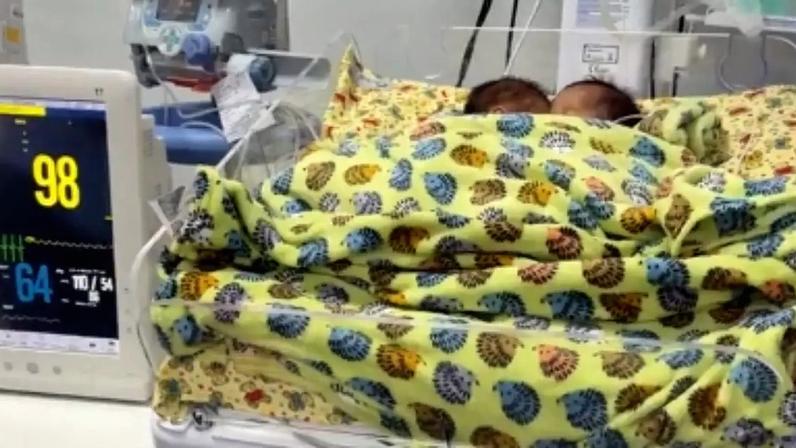 Bebês siameses nasceram em maio, em Goiânia