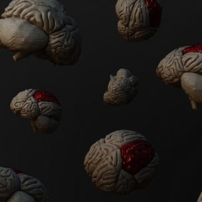 Cientistas japoneses testam células-tronco para tratar Parkinson pela 1ª vez