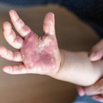 MG teve vítima diária em incêndios ou explosões em 2025; medidas de autoproteção