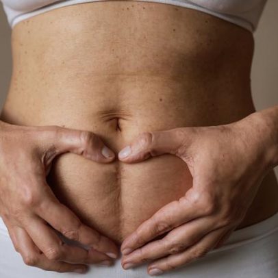 Barriga que não volta após gravidez pode ser diástase