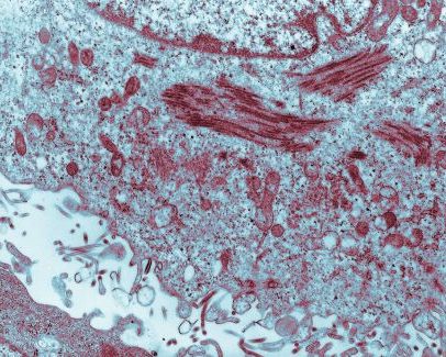 Suspeitas de Ebola no Brasil são descartadas; veja o que se sabe