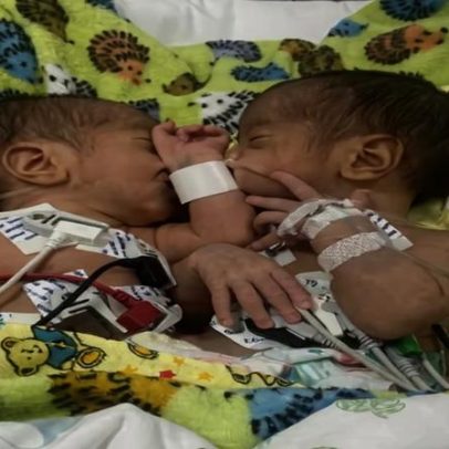 Gêmeos unidos pelo abdômen morrem 4 dias antes de cirurgia em Goiás