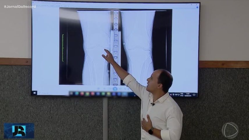 Programa de inteligência artificial desenvolvido em MG ajuda a detectar artrose precocemente