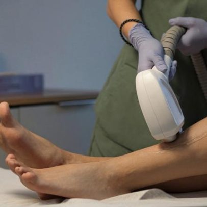 Espaço Laser indenizará cliente por queimadura de 2º grau em sessão