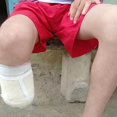 Homem é condenado por amputação visando seguro de 1,5 milhão de reais
