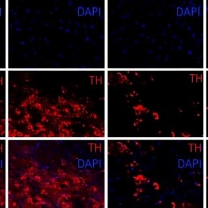 Estudo brasileiro aponta molécula anti-inflamatória para frear Parkinson