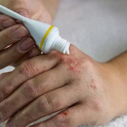 Rinite, asma e dermatite: alergias comuns e cuidados necessários