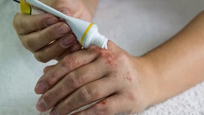 Alergias são comuns em todo o mundo