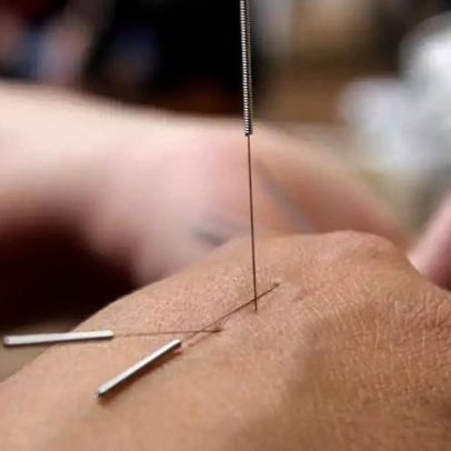 Acupuntura atua no cérebro e no corpo para aliviar dor crônica